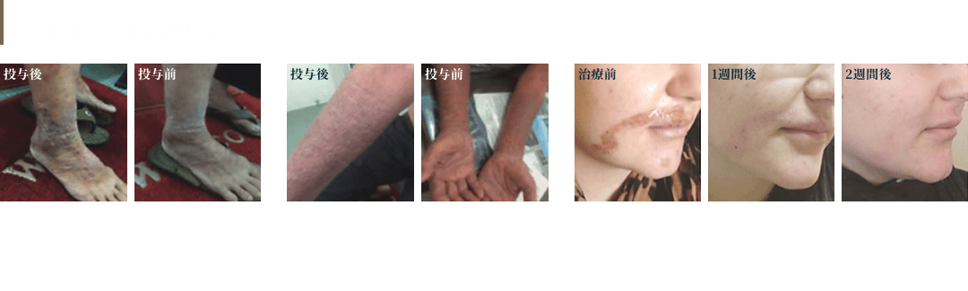 プラセンタの投与